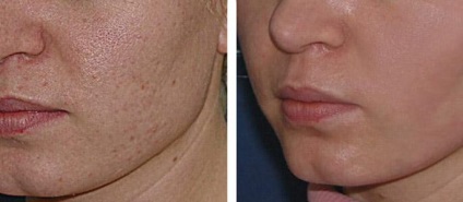 curățare facială la cosmeticiana ceea ce este, descrierea și metoda folosită - viața mea (cosmetolog fata este) curățare facială la cosmeticiana ceea ce este, descrierea și metoda folosită - viața mea