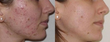 curățare facială la cosmeticiana ceea ce este, descrierea și metoda folosită - viața mea (cosmetolog fata este) curățare facială la cosmeticiana ceea ce este, descrierea și metoda folosită - viața mea