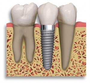 Ce se întâmplă dacă implanturile dentare nu poate fi vorba de sănătate, frumusețe și sport (dinții de pe ambele părți) Ce se întâmplă dacă implantarea nu poate fi vorba de sanatate, frumusete si sport