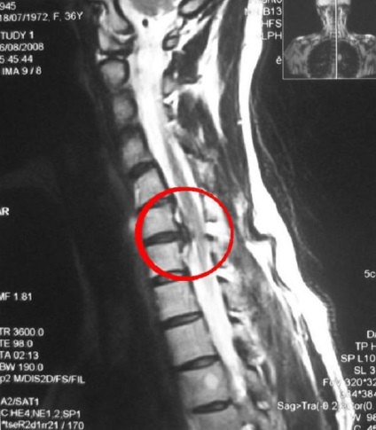 Ce face RMN-ul a coloanei vertebrale (care arata RMN lombar kreststovogo departament) Asta arată RMN-ul coloanei vertebrale