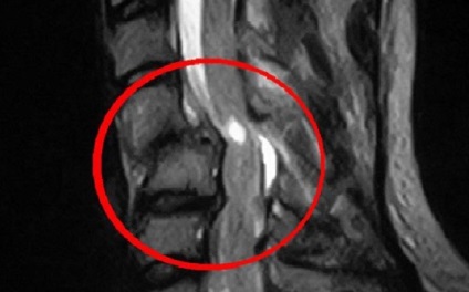 Ce face RMN-ul a coloanei vertebrale (care arata RMN lombar kreststovogo departament) Asta arată RMN-ul coloanei vertebrale