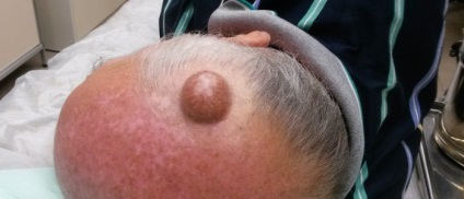 Ce este aterom cauze, simptome, prevenirea (a) Ce este aterom cauze, simptome, prevenirea