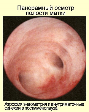 Ce este atrofia endometrului (atrofie endometrială a mucoasei) Ce este atrofia endometrială