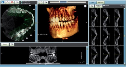 Ce este o tomografie computerizata dentară și în cazul în care acesta este utilizat (CT dentar) Ce este o tomografie computerizata dentară și în cazul în care se aplică