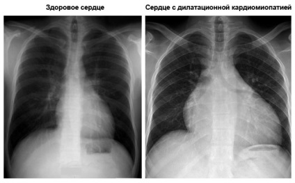 cardiomiopatie dilatativă este ceea ce este, cauzele, simptomele și tratamentul (a) cardiomiopatie dilatativă este ceea ce este, cauze, simptome și tratament