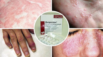 Diprophos psoriazis - instrucțiuni de utilizare și de feedback (Diprophos) Diprophos psoriazis - instrucțiuni de utilizare și feedback