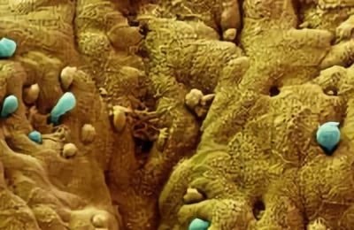 dizenterie amoebic - ceea ce este, cauze, tratament, prognosticul si rezultatul (dizenterie) dizenterie amoebic - ceea ce este, cauze, tratament, prognosticul si rezultatul