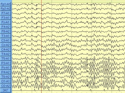 EEG (electroencefalograf) pentru pacienții și părinții lor - medicina bazata pe dovezi pentru toate