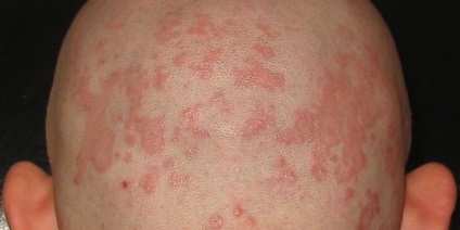 Eczema pe părul capului într-un copil sau adult - cauzele si tratamente (cap) Eczema pe părul capului într-un copil sau adult - cauzele și tratamentul
