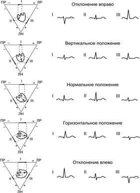 Axa electrică a inimii (caracterizate uglomot semne ECG) Axa electrică a inimii