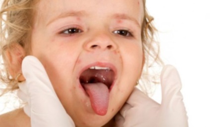 Mână, febră aftoasă cauze și tratament (enterovirus) Mână, febră aftoasă cauze și tratament