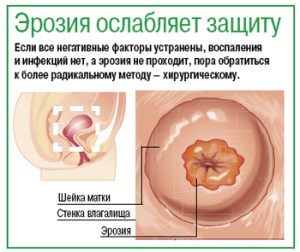 Efectele de eroziune de col uterin ale bolii decât riscul de eroziune (uterului) Efectele de eroziune de col uterin ale bolii decât riscul de eroziune
