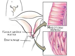 Efectele de eroziune de col uterin ale bolii decât riscul de eroziune (consecințele) Efectele de eroziune de col uterin ale bolii decât riscul de eroziune