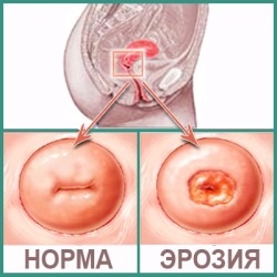Efectele de eroziune de col uterin ale bolii decât riscul de eroziune (de col uterin) Efectele de eroziune de col uterin ale bolii decât riscul de eroziune