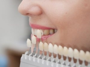 1 restaurare dentară estetică (restaurare) restaurare dentară estetică 1