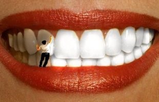 restaurare dentară estetică 1 (după furnire de instalare) restaurare dentară estetică 1