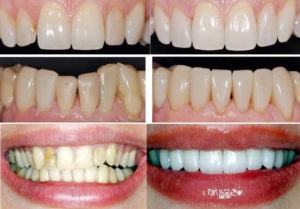 1 restaurare dentară estetică (restaurare) restaurare dentară estetică 1
