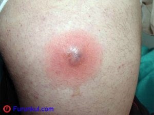 Abraziuni - cauze si tratament cu antibiotice (foto) (antibiotice) Abraziuni - cauze si tratament cu antibiotice (foto)