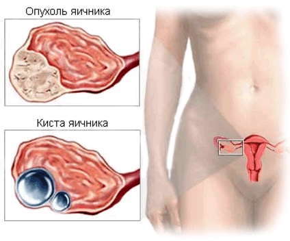 Tumorile cu celule germinale, novoston (limfatici retroperitoneal nod biopsie) Tumorile cu celule germinale, novoston