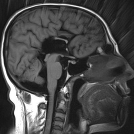 Hipoplazia calos a creierului a corpului de simptome ale unui copil nou-nascut, consecinte si