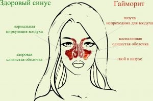 tratament sinuzita purulentă la domiciliu (acasa) tratament sinuzita purulentă la domiciliu