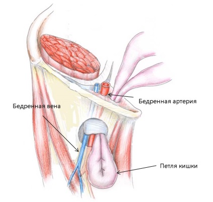 Cauzele abdominale hernie, tipuri de complicații (hernie) hernie abdominală cauze, tipuri