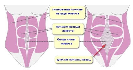 Cauzele abdominale hernie, tipuri (iesire in afara de organe interne) hernie abdominală cauze, tipuri