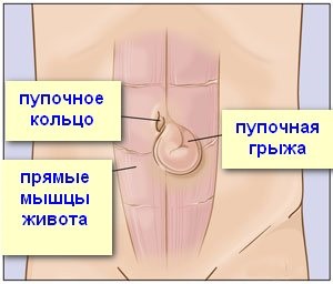 hernie abdominală cauze, tipuri (în cazul în care este luat hernia) hernie abdominală cauze, tipuri