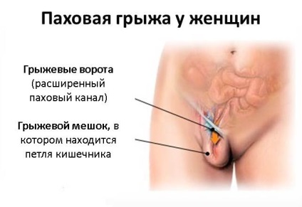 hernie abdominală cauze, tipuri (în cazul în care este luat hernia) hernie abdominală cauze, tipuri