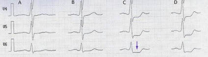 infarct miocardic (există dinte patologic) infarct miocardic