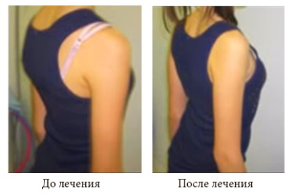 Curbarea coloanei vertebrale (scolioza „Clinica) curbura spinării