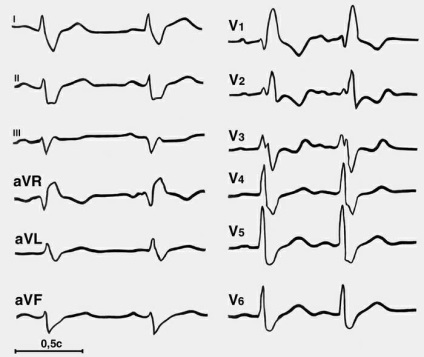 Cum să învețe să citească tutoriale video de ECG (a învăța cum să citească tutoriale video ECG) Cum să învețe să citească lecțiile ECG video de