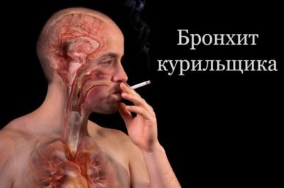 tuse fumator cum sa scapi de simptomele si tratamentul la domiciliu (acasa) tuse fumator cum sa scapi de simptomele si tratamentul la domiciliu