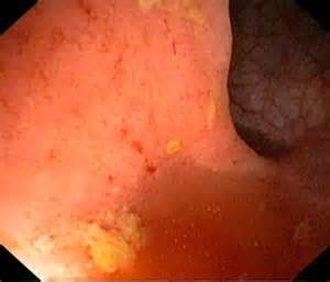 Catarale Proctosigmoiditis - simptome și tratament de remedii populare (tratament) Catarale Proctosigmoiditis - simptome și tratament de remedii populare