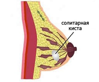 Chist de tipuri de san, cauze, simptome si diagnostic (chist) Chist de tipuri de san, cauze, simptome si diagnostic