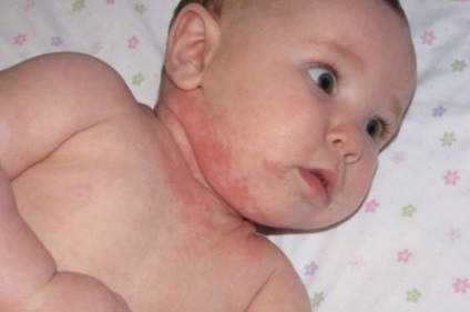 dermatita atopica Komorowski la copii (copii de Dr. Komarovsky) Komorowski a dermatitei atopice la copii