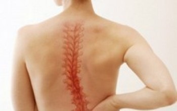 Tratamentul conservator al simptomelor scolioză adult, semne, terapie fizică, chirurgie, profilaxie (simptome) Tratamentul conservator scoliozei la simptome adulti, semne, terapie fizică, chirurgie, prevenire