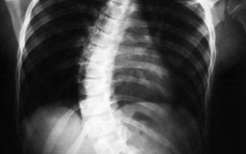 Tratamentul conservator al simptomelor scolioză adult, semne, terapie fizică, chirurgie, profilaxie (tratamentul conservator al simptomelor scolioză adulte de prevenire a funcționării fizioterapie semne) Tratamentul conservator scoliozei la simptome adulti, semne, terapie fizică, chirurgie, prevenire