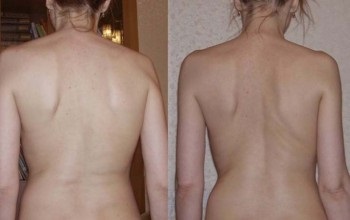Tratamentul conservator al simptomelor scolioză adult, semne, terapie fizică, chirurgie, profilaxie (scolioză) Tratamentul conservator scoliozei la simptome adulti, semne, terapie fizică, chirurgie, prevenire