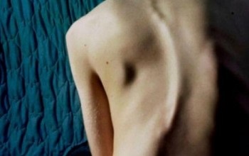 Tratamentul conservator al simptomelor scolioză adult, semne, terapie fizică, chirurgie, profilaxie (tratamentul conservator al simptomelor scolioză adulte de prevenire a funcționării fizioterapie semne) Tratamentul conservator scoliozei la simptome adulti, semne, terapie fizică, chirurgie, prevenire