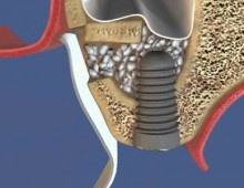 Osteoplasty atrofie a osului, metode de osteoplasty (plastic) Bone altoire atrofie a țesutului osos, tehnici osteoplasty