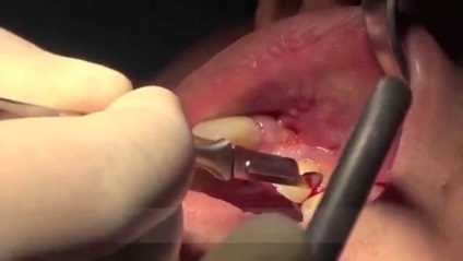 Osteoplasty atrofie a osului, metode de osteoplasty (plastic) Bone altoire atrofie a țesutului osos, tehnici osteoplasty