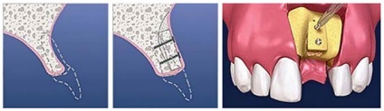 Osteoplasty atrofie a osului, a metodelor de osteoplasty (atrofie) Bone altoire atrofie a țesutului osos, tehnici osteoplasty