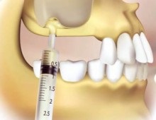 Osteoplasty atrofie a osului, a metodelor de osteoplasty (atrofie) Bone altoire atrofie a țesutului osos, tehnici osteoplasty