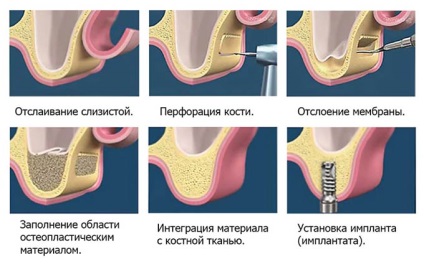 Osteoplasty atrofie a osului, metode de osteoplasty (plastic) Bone altoire atrofie a țesutului osos, tehnici osteoplasty