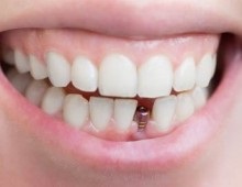 Osteoplasty atrofie a osului, metode de osteoplasty (plastic) Bone altoire atrofie a țesutului osos, tehnici osteoplasty