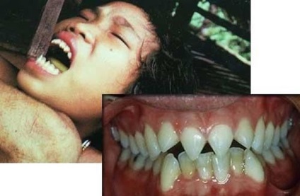 Frumusete - forță teribilă (liposuctie) Frumusete - forță teribilă