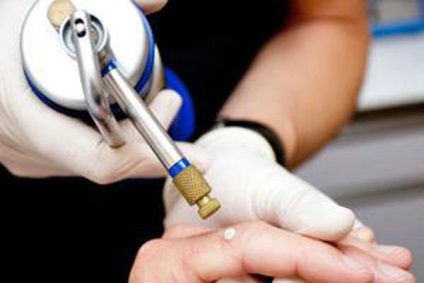 negii Criodistrucția - care este, pret, comentarii, ștergerea, după ce copiii, plantara, lichid (elimina) negii Criodistrucția - care este, preț, comentarii, ștergerea, după ce copiii, plantară, lichid