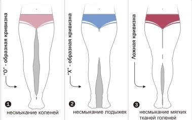 picioare strâmbe (îmbrăcăminte) picioare bandy