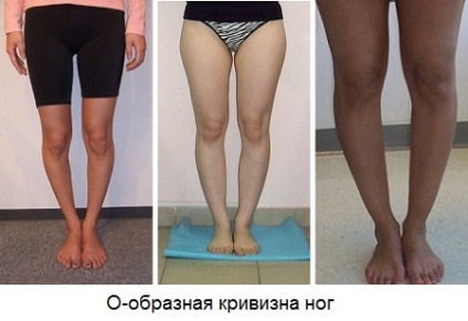 picioare strâmbe (yoga) picioare bandy
